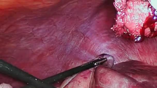Karın boşluğu içinde işlem laparoskopi sırasında. — Stok video