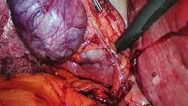 Abdominal cavity inside during operation laparoscopy. — Stock Video