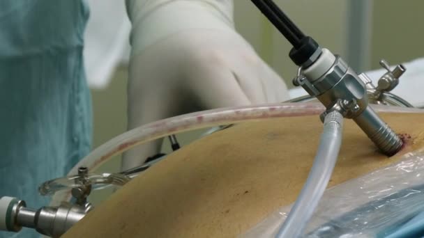 Laparoscopia abdominal en primer plano en quirófano . — Vídeo de stock