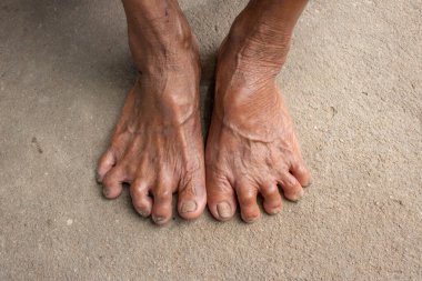 Foot Senior 'lar. Kirli ayaklar havanda. tırnak mantarı.