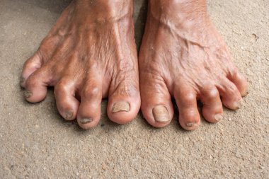 Foot Senior 'lar. Kirli ayaklar havanda. tırnak mantarı.