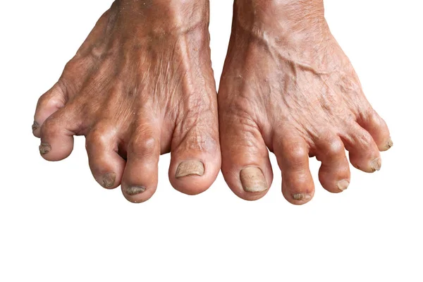Närbild Fot Seniorer Smutsiga Fötter Murbruk Tånagelsvamp Svampinfektion Naglarna Människans — Stockfoto