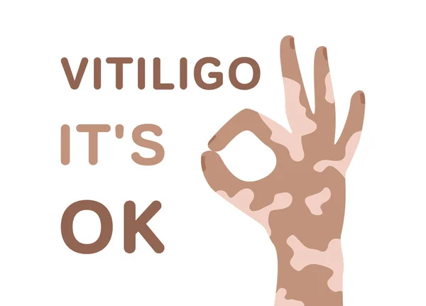 Vitiligo海报 人类的手和文字白羊座 没关系 颜色平坦 说明身体是积极的 自爱的 白色背景上的孤立矢量图像 — 图库矢量图片