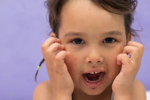 Little Girl Chicken Pox Scribbling His Bumps — Stock Photo, Image