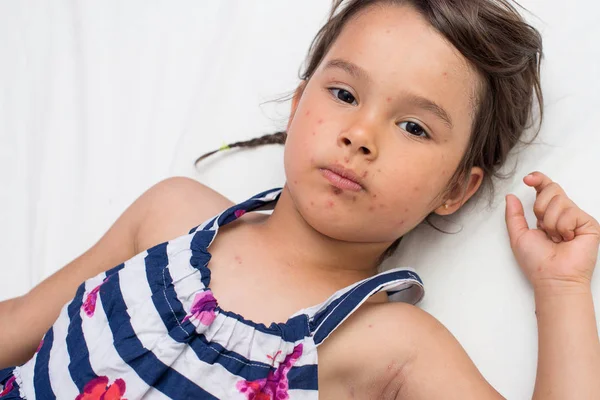 Κοριτσάκι Ανεμευλογιάς Ανεμοβλογιά Μικρή Φλυκταινώδη Νόσο — Φωτογραφία Αρχείου