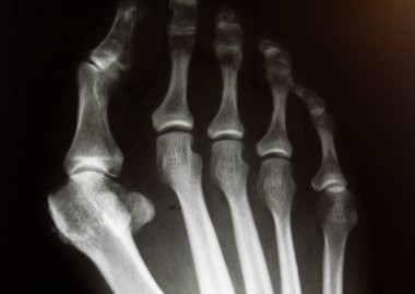 Hallux valgus deformasyonlu ön ayağın X-Ray görüntüsü