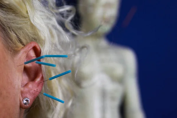 Close up of human female ear with blue needles: Ear acupuncture as a form of alternative chinese medicine