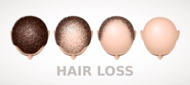 Saç dökülmesi. Dört aşamalı alopecia seti. Eps8. RGB Genel Renkleri