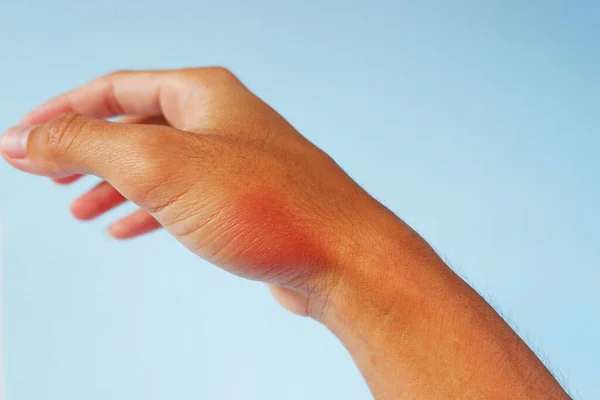 Swelling Symptom Red Skin Hand Catching Mouse Too Often — Stock Photo, Image