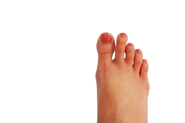 Foot Toes Asian Woman Which Has Index Finger Longer Thumb — Stock Photo, Image