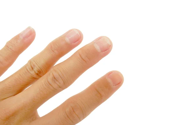 Nägel Mit Dem Auftreten Von Pilzerkrankungen Auf Nägeln Isoliert Auf — Stockfoto