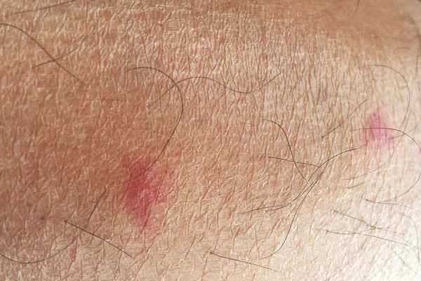 Big Red Blister Legs Caused Mosquito Bites — Stock Photo, Image