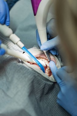 Optragate üzerinden ağzını aç. Diş hekimliği.