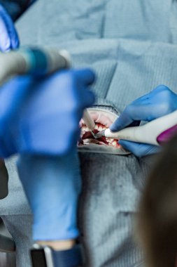 Optragate üzerinden ağzını aç. Diş hekimliği.