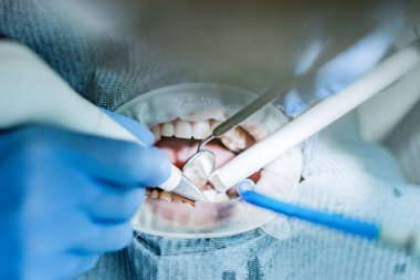 Optragate üzerinden ağzını aç. Diş hekimliği.