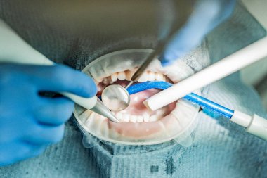 Optragate üzerinden ağzını aç. Diş hekimliği.