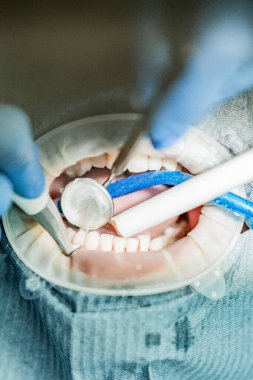 Optragate üzerinden ağzını aç. Diş hekimliği.