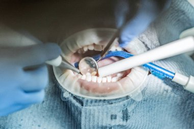 Optragate üzerinden ağzını aç. Diş hekimliği.