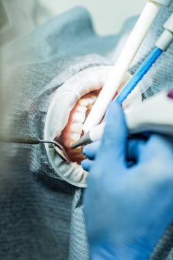 Optragate üzerinden ağzını aç. Diş hekimliği.