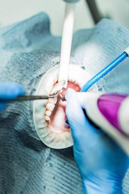 Optragate üzerinden ağzını aç. Diş hekimliği.