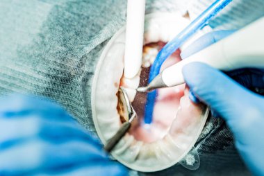 Optragate üzerinden ağzını aç. Diş hekimliği.