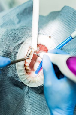 Optragate üzerinden ağzını aç. Diş hekimliği.