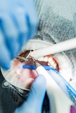 Optragate üzerinden ağzını aç. Diş hekimliği.