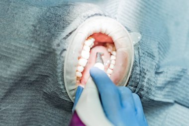 Optragate üzerinden ağzını aç. Diş hekimliği.