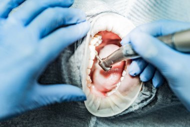 Optragate üzerinden ağzını aç. Diş hekimliği.