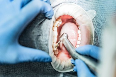 Optragate üzerinden ağzını aç. Diş hekimliği.