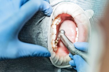 Optragate üzerinden ağzını aç. Diş hekimliği.