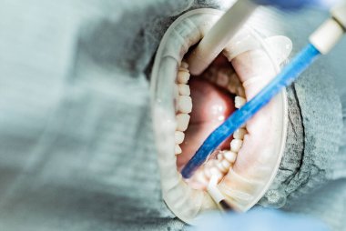 Optragate üzerinden ağzını aç. Diş hekimliği.