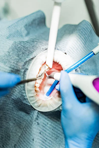 Optragate üzerinden ağzını aç. Diş hekimliği.