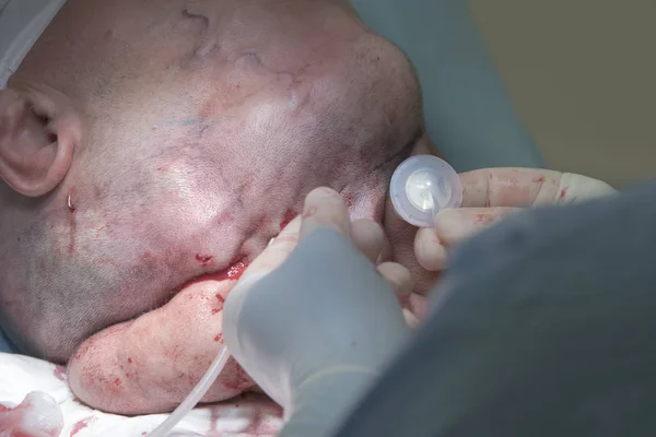 Kirurgen Håller Vävnad Expander Innan Inställningen Huvudet Huden Huvudet Tumör — Stockfoto