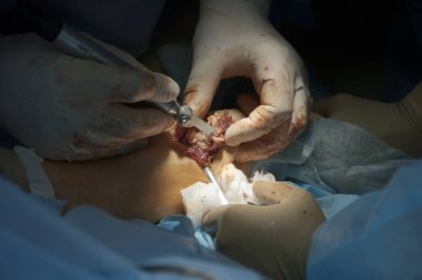 Ameliyatta ulna kemiği ve kan lekeli cerrahın eldivenleri ile yakın çekimde cerrahi testere kullanımı