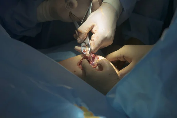 Uso chirurgico dei capezzoli — Foto Stock