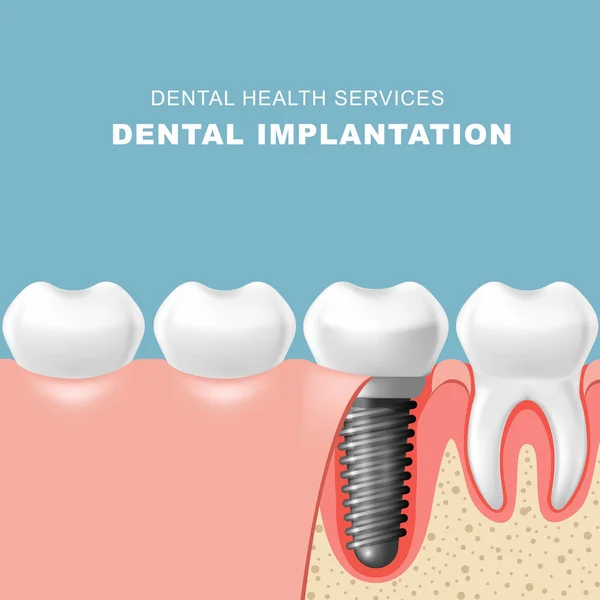 Implante Dental Dental Insertado Encía Implante Dental — Vector de stock