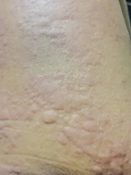 寒冷蕁麻疹アレルギー性発疹のビューを閉じます かゆみを伴うじんましんの症状 — ストック写真