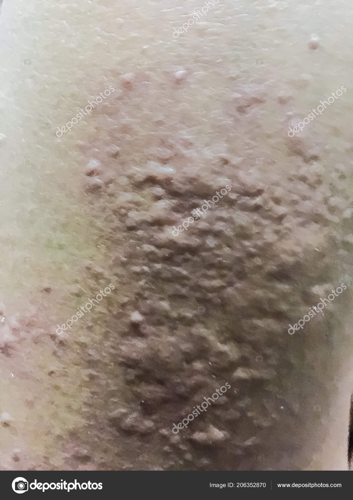 Close View Cold Urticaria Allergic Rash Symptoms Itchy Urticaria ...