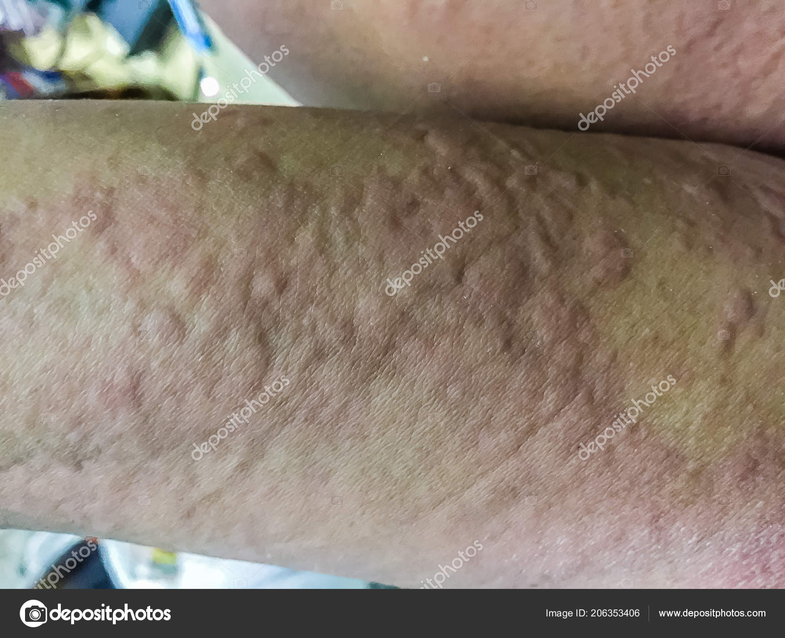 Close View Cold Urticaria Allergic Rash Symptoms Itchy Urticaria
