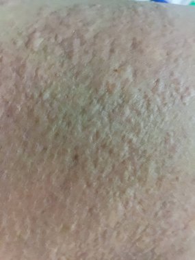 Soguk Ürtikeri Alerjik döküntü görünümünü kapatın. Kaşıntılı ürtiker belirtileri.