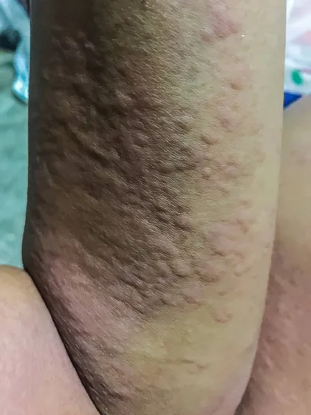 Close View Cold Urticaria Allergic Rash Symptoms Itchy Urticaria Stock ...