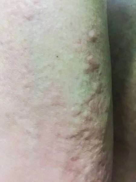 Close View Cold Urticaria Allergic Rash Symptoms Itchy Urticaria Stock ...