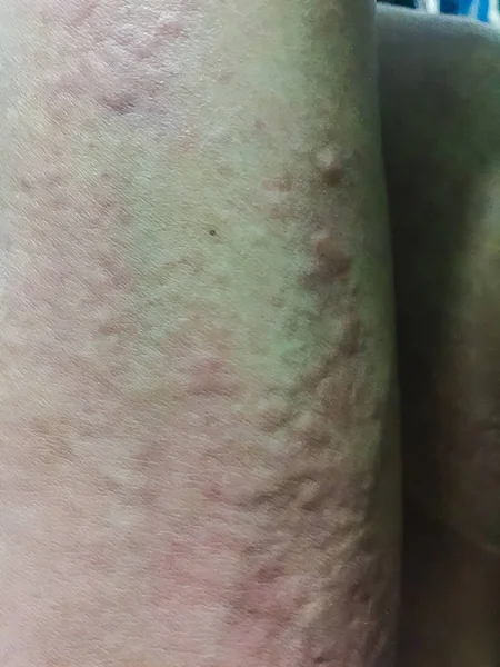 Zár Megjelöl Kilátás Hideg Urticaria Allergiás Kiütés Tünetek Viszkető Csalánkiütés — Stock Fotó