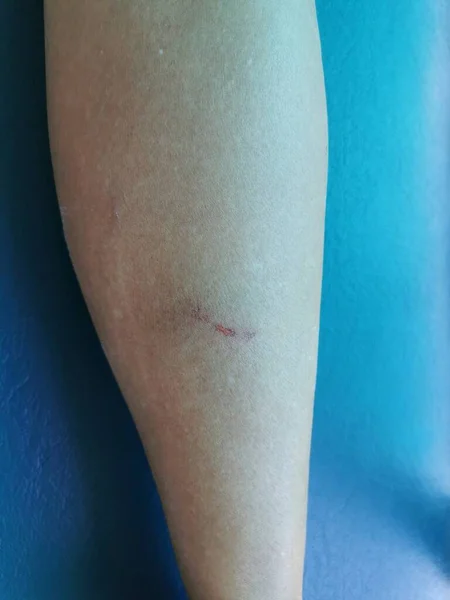 一个年轻的亚洲女人的腿被狗打伤了 — 图库照片