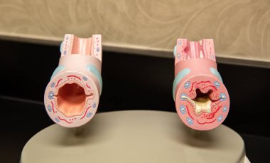 sağlıklı akciğer dokusu ve iltihaplı akciğer dokusu modelleri