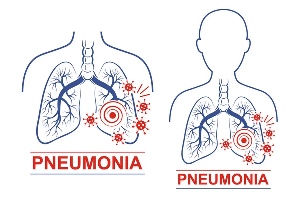 Conjunto Iconos Enfermedad Neumonía Pulmones Humanos Anatomía Tráquea Tratamiento Neumonía — Archivo Imágenes Vectoriales