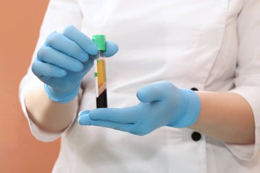 Prp tedavisi için elinde kan plazması