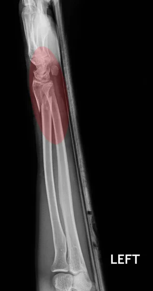 Fracture Shaft Radius Ulnar Bone Ray Film — Stock Photo, Image