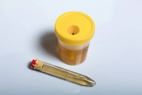 Urine in test container and vacuum tube. Disposable medical polymeric sterile container with a built-in holder for a vacuum test tube with a screw cap.